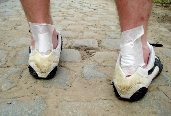 水泡 靴擦れ 手湿疹で水疱（水ぶくれ）ができた場合の治し方〜ほかの病気が原因になっている可能性も〜